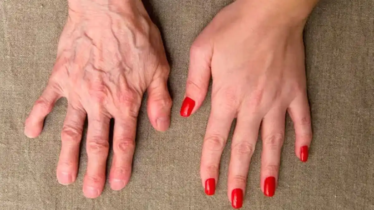 Předčasné vrásky na rukou a suchá pokožka Podívejte se na příčiny a jednoduché způsoby, jak mít ruce hebké