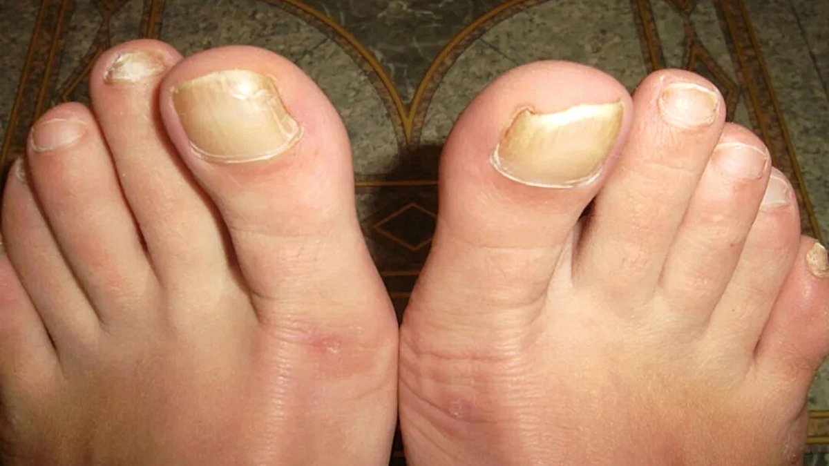 Tlusté a žluté nehty obyčejný fén zachrání nohy lépe než jakékoli krémy